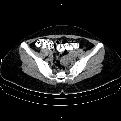 Bartholin gland cyst (Radiopaedia 62635-70930 Axial non-contrast 33).jpg