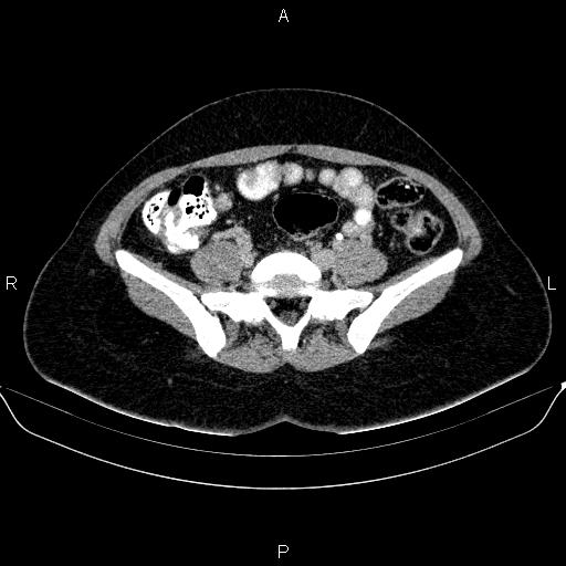 Bartholin gland cyst (Radiopaedia 62635-70930 C 13).jpg