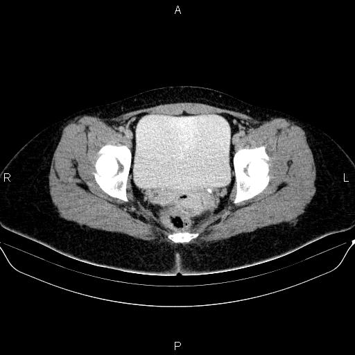 Bartholin gland cyst (Radiopaedia 62635-70930 C 61).jpg