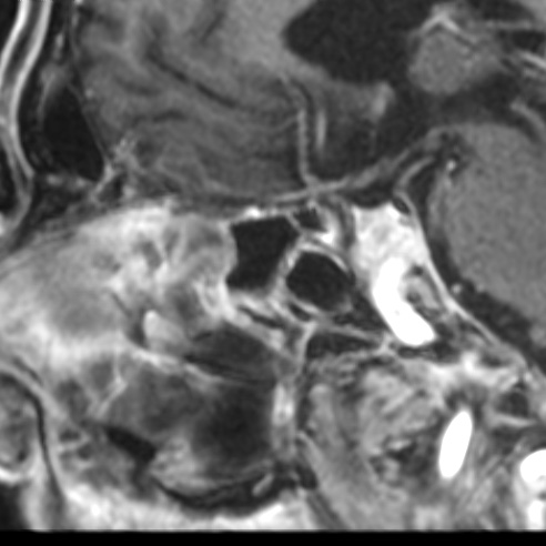 File:Basal cell carcinoma (periorbital) (Radiopaedia 55179-61559 F 20).jpg