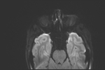 File:Basal cell carcinoma - nasal region (Radiopaedia 70292-80365 Axial DWI 22).jpg