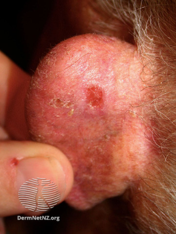 File:Basal cell carcinoma affecting the ear (DermNet NZ lesions-bcc-ear-1185).jpg