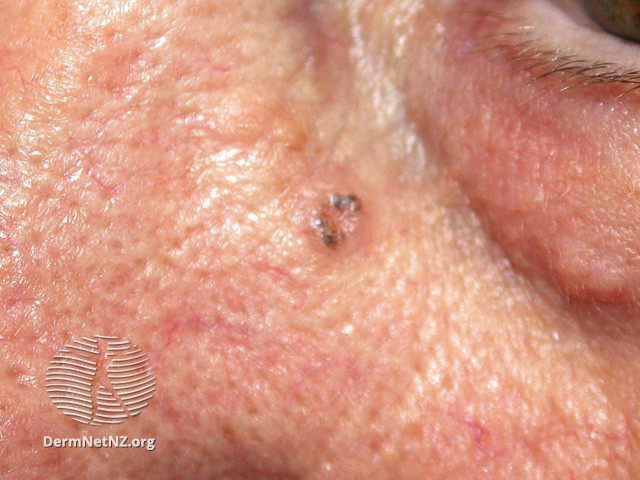 Basal cell carcinoma affecting the face (DermNet NZ lesions-bcc-face-0845).jpg
