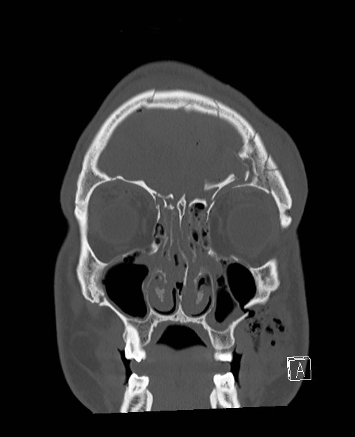 Base of skull fracture with bilateral Le Fort fractures (Radiopaedia 47094-51638 Coronal bone window 79).jpg