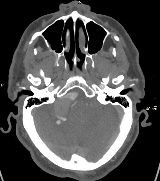 Basilar artery aneurysm (Radiopaedia 56261-62932 A 49).jpg