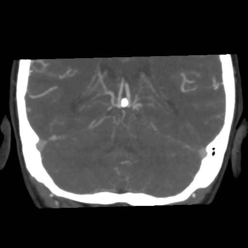 Basilar artery fenestration and aneurysms with subarachnoid hemorrhage (Radiopaedia 40066-42573 B 38).png