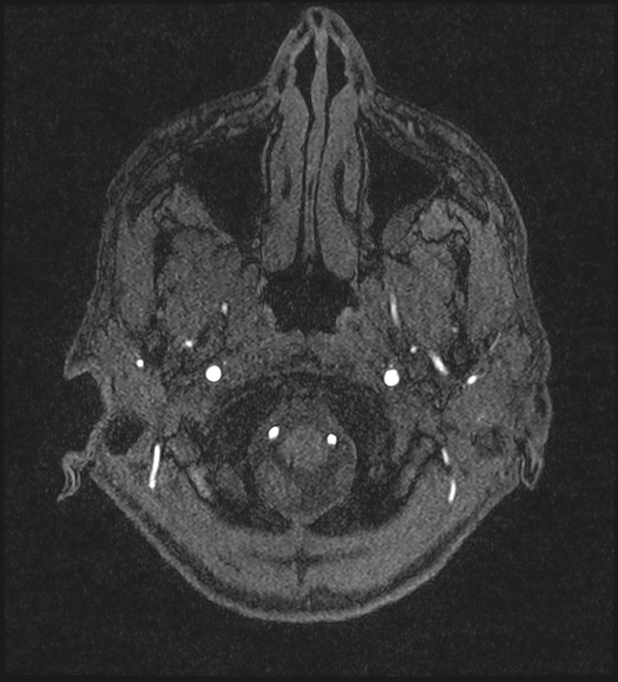 Basilar artery perforator aneurysm (Radiopaedia 82455-97733 Axial MRA 19).jpg