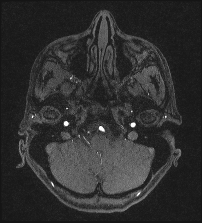 Basilar artery perforator aneurysm (Radiopaedia 82455-97733 Axial MRA 47).jpg