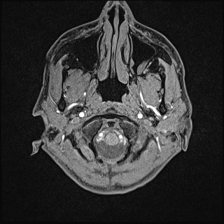 Basilar artery perforator aneurysm (Radiopaedia 82455-97733 Axial T1 fat sat 1).jpg