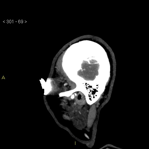 Basilar artery thrombosis (Radiopaedia 16260-15944 C 63).jpg