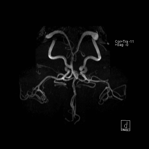 Basilar tip aneurysm (Radiopaedia 26504-26632 D 15).jpg
