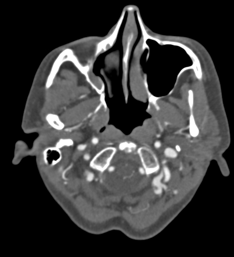 File:Basilar tip aneurysm with coiling (Radiopaedia 53912-60086 A 16).jpg