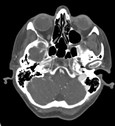 Basilar tip aneurysm with coiling (Radiopaedia 53912-60086 A 32).jpg