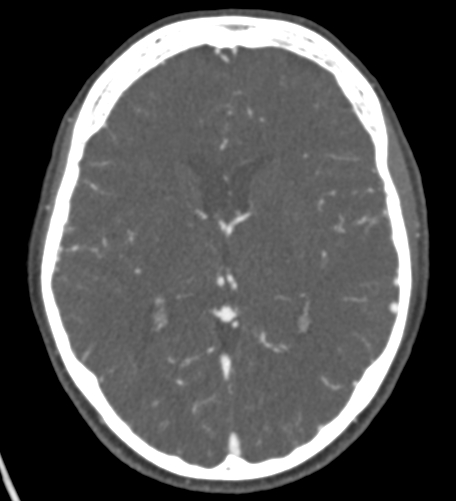 Basilar tip aneurysm with coiling (Radiopaedia 53912-60086 A 81).jpg