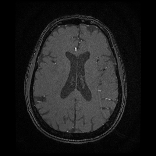 Basilar top and left middle cerebral artery aneurysm (Radiopaedia 61965-70031 Axial MRA 105).jpg