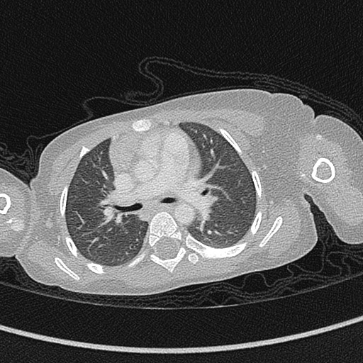 Beckwith-Wiedeman syndrome with bilateral Wilms tumors (Radiopaedia 60850-68629 Axial lung window 28).jpg
