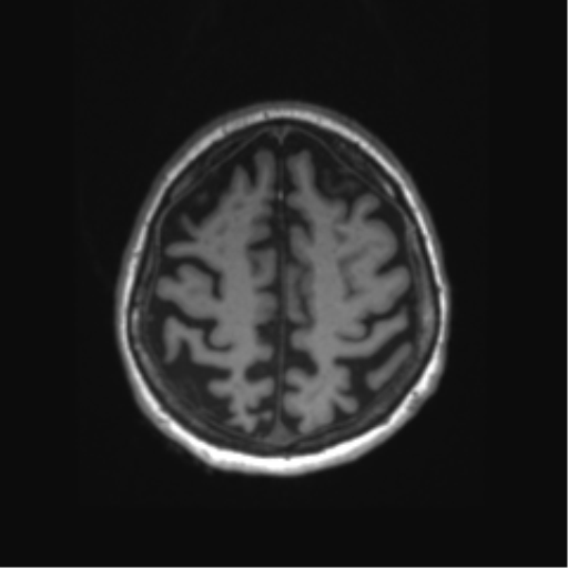 Behavioral variant frontotemporal dementia and late onset schizophrenia (Radiopaedia 52197-58083 Axial T1 14).png