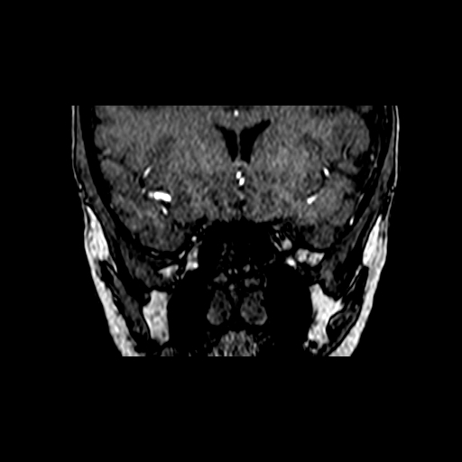 Berry aneurysm of the terminal internal carotid artery (Radiopaedia 88286-104918 Coronal TOF 23).jpg