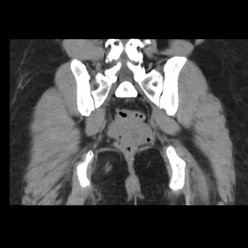 File:Bicornuate uterus (MRI) (Radiopaedia 49206-54296 Coronal 12).jpg