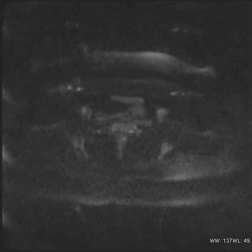 File:Bicornuate uterus (MRI) (Radiopaedia 49206-54297 Axial 103).jpg