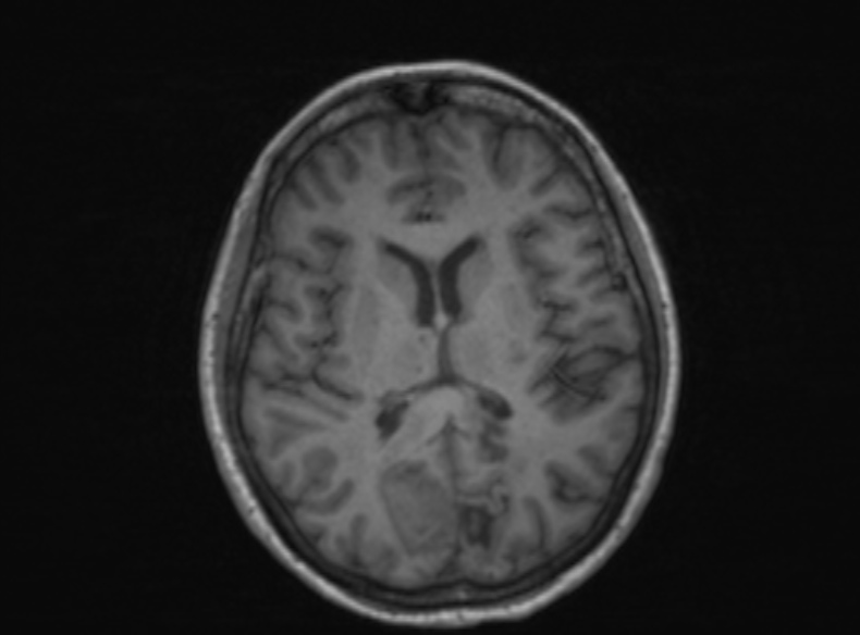 Bilateral PCA territory infarction - different ages (Radiopaedia 46200-51784 Axial T1 220).jpg