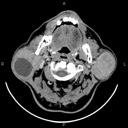File:Bilateral Warthin tumors (Radiopaedia 84034-99263 Axial With contrast 23).jpg
