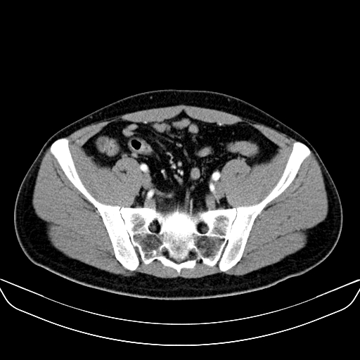 Bilateral accessory renal arteries with mild pelvi-ureteric junction (PUJ) obstruction (Radiopaedia 66357-75596 A 54).jpg