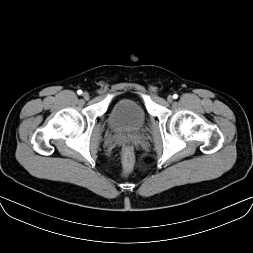 File:Bilateral accessory renal arteries with mild pelvi-ureteric junction (PUJ) obstruction (Radiopaedia 66357-75596 A 73).jpg