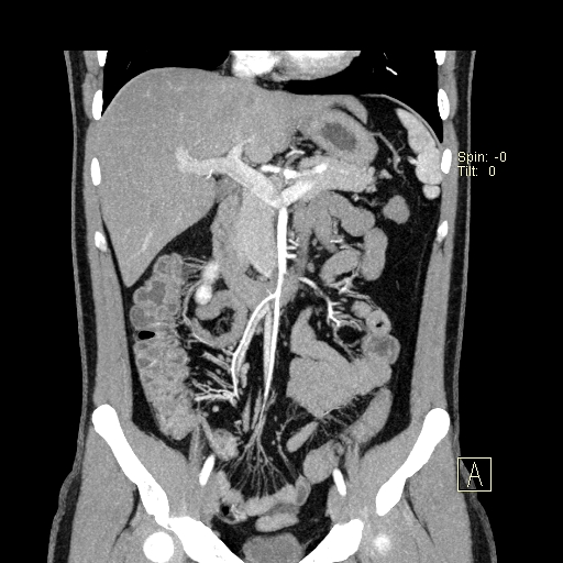 File:Bilateral accessory renal arteries with mild pelvi-ureteric junction (PUJ) obstruction (Radiopaedia 66357-75596 B 9).jpg