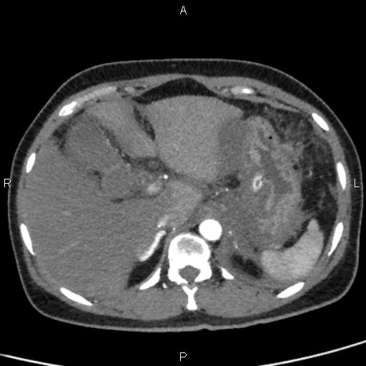 Bilateral adrenal gland hyperenhancement in pancreatitis (Radiopaedia 86642-102753 B 27).jpg