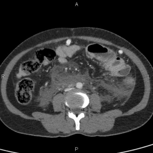 Bilateral adrenal gland hyperenhancement in pancreatitis (Radiopaedia 86642-102753 E 66).jpg