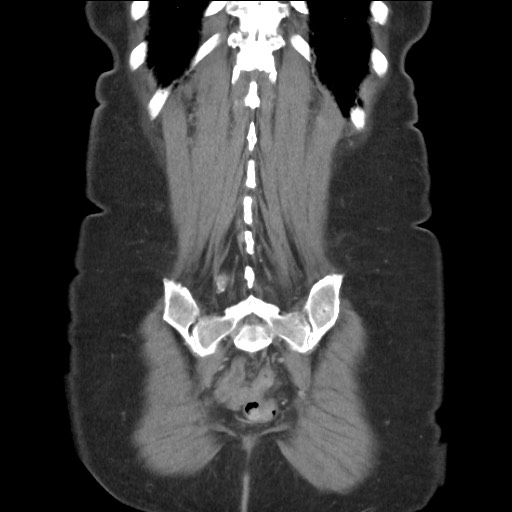 Bilateral adrenal granulocytic sarcomas (chloromas) (Radiopaedia 78375-91007 B 79).jpg
