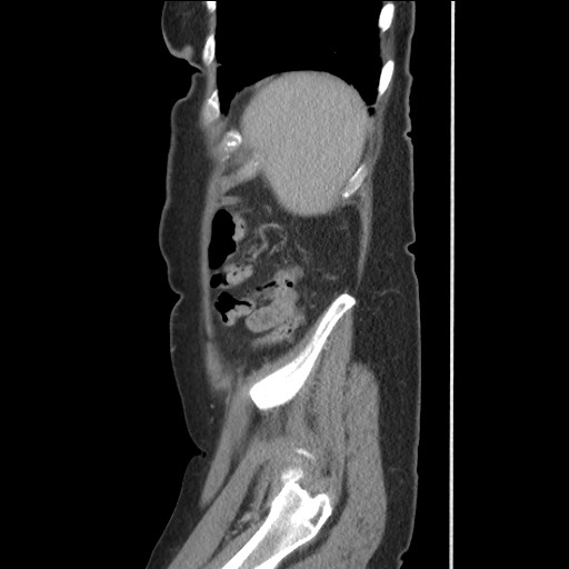 Bilateral adrenal granulocytic sarcomas (chloromas) (Radiopaedia 78375-91007 C 115).jpg