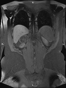 Bilateral adrenal myelolipoma (Radiopaedia 63058-71537 Coronal T1 fat sat 21).jpg