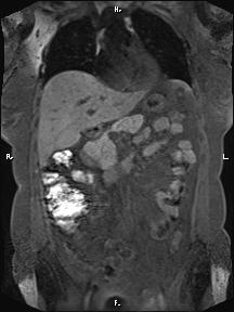 Bilateral adrenal myelolipoma (Radiopaedia 63058-71537 Coronal T1 fat sat 67).jpg