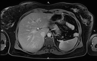 Bilateral adrenal myelolipoma (Radiopaedia 63058-71537 H 26).jpg