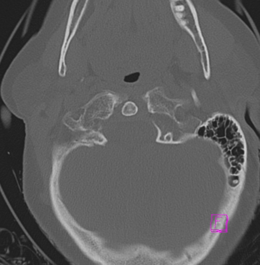 File:Bilateral atlanto-occipital assimilation (Radiopaedia 28350-28603 Axial bone window 7).jpg
