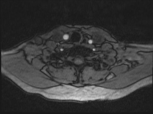 Bilateral carotid body tumors and right glomus jugulare tumor (Radiopaedia 20024-20060 Axial MRA 198).jpg