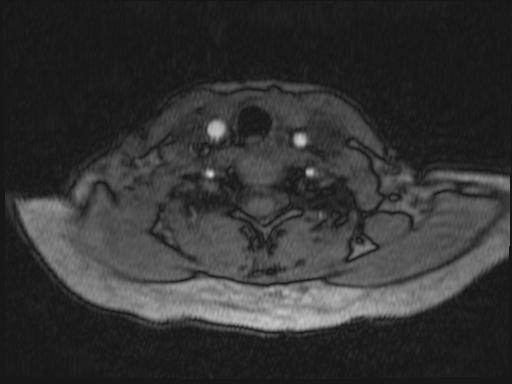 Bilateral carotid body tumors and right glomus jugulare tumor (Radiopaedia 20024-20060 Axial MRA 205).jpg