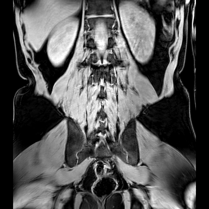 Bilateral conjoined nerve roots at different levels (Radiopaedia 73312-84063 Coronal WE 40).jpg