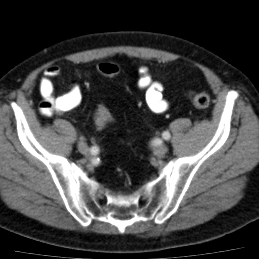 File:Bilateral direct inguinal herniae (Radiopaedia 17016-16719 B 3).jpg