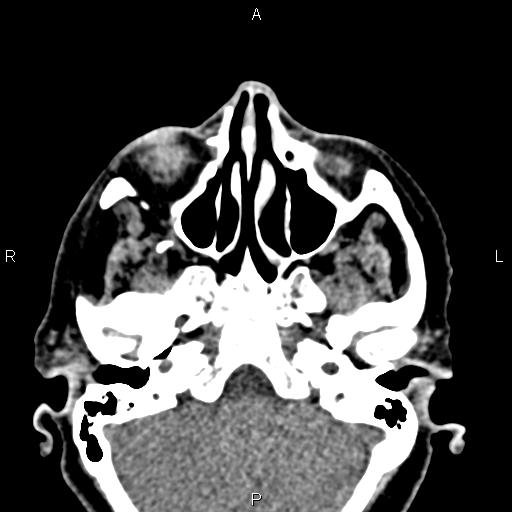Bilateral enlargement of lacrimal glands - sarcoidosis (Radiopaedia 62627-70921 Axial non-contrast 24).jpg