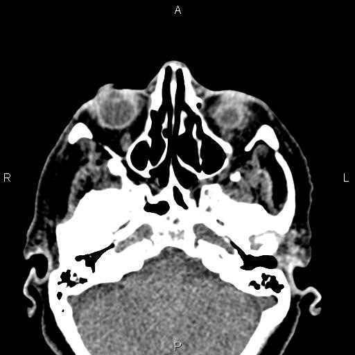 File:Bilateral enlargement of lacrimal glands - sarcoidosis (Radiopaedia 62627-70921 Axial non-contrast 29).jpg