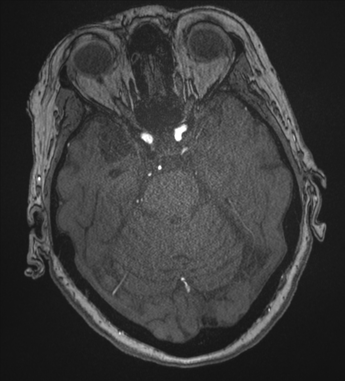 Bilateral fetal posterior communicating arteries (Radiopaedia 41286-44102 Axial MRA 66).png