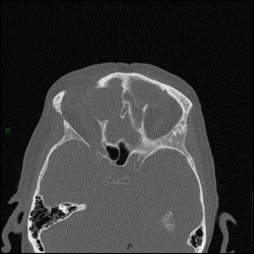 Bilateral frontal mucoceles (Radiopaedia 82352-96454 Axial bone window 122).jpg