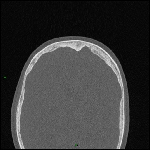 Bilateral frontal mucoceles (Radiopaedia 82352-96454 Axial bone window 53).jpg