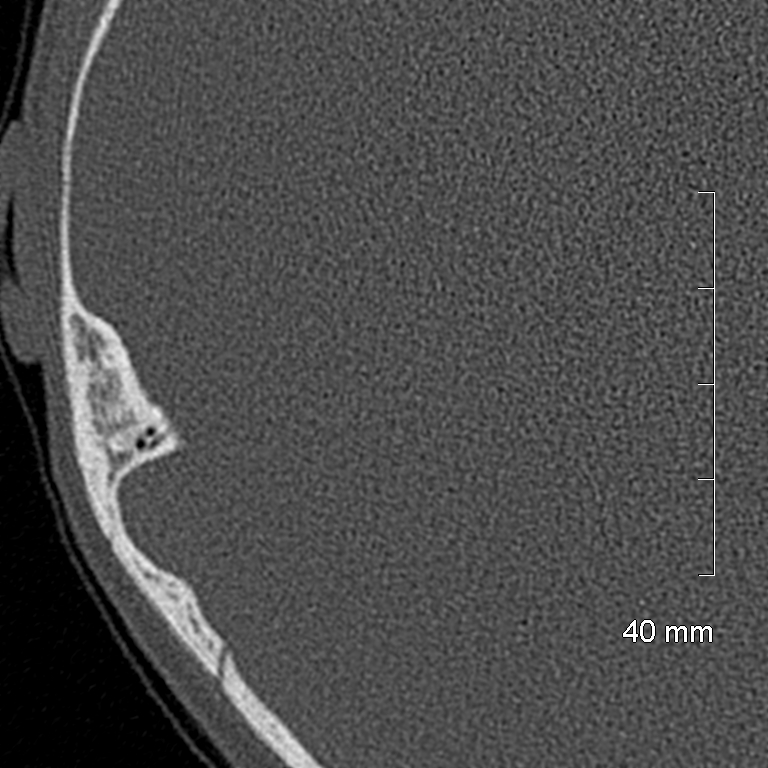 Bilateral grommets (Radiopaedia 47710-52404 Axial bone window 67).jpg