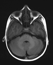 File:Bilateral mesial temporal polymicrogyria (Radiopaedia 76456-88181 Axial T1 6).jpg