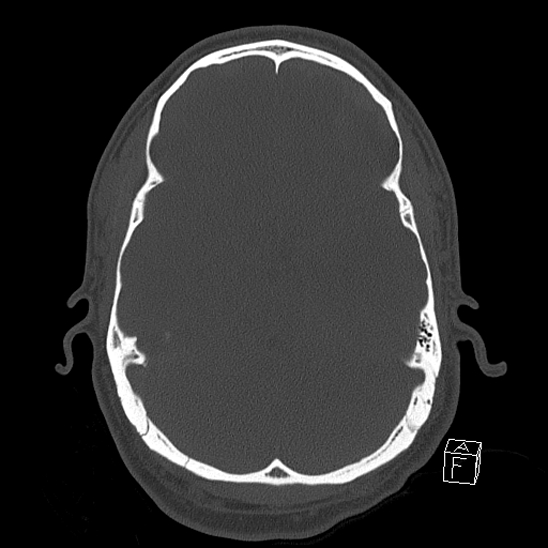 Bilateral occipital condyle fracture (type 2) (Radiopaedia 87675-104089 Axial bone window 48).jpg