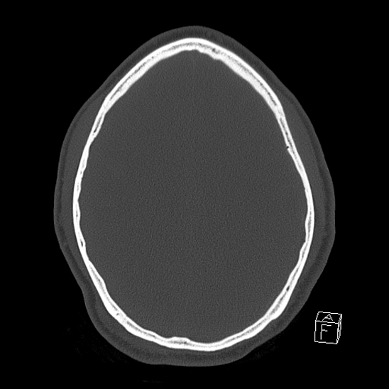 Bilateral occipital condyle fracture (type 2) (Radiopaedia 87675-104089 Axial bone window 92).jpg